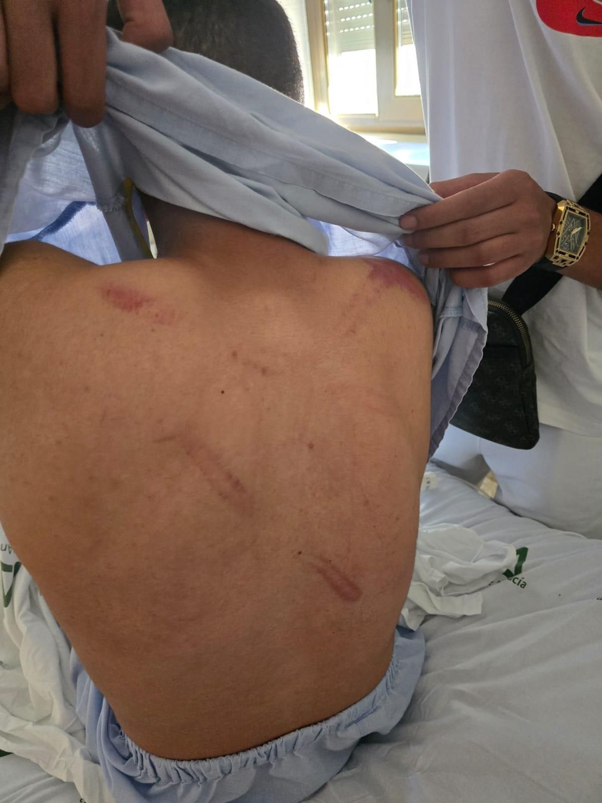 Lesiones en la espalda de Oussama I. R., en una imagen facilitada por la familia.