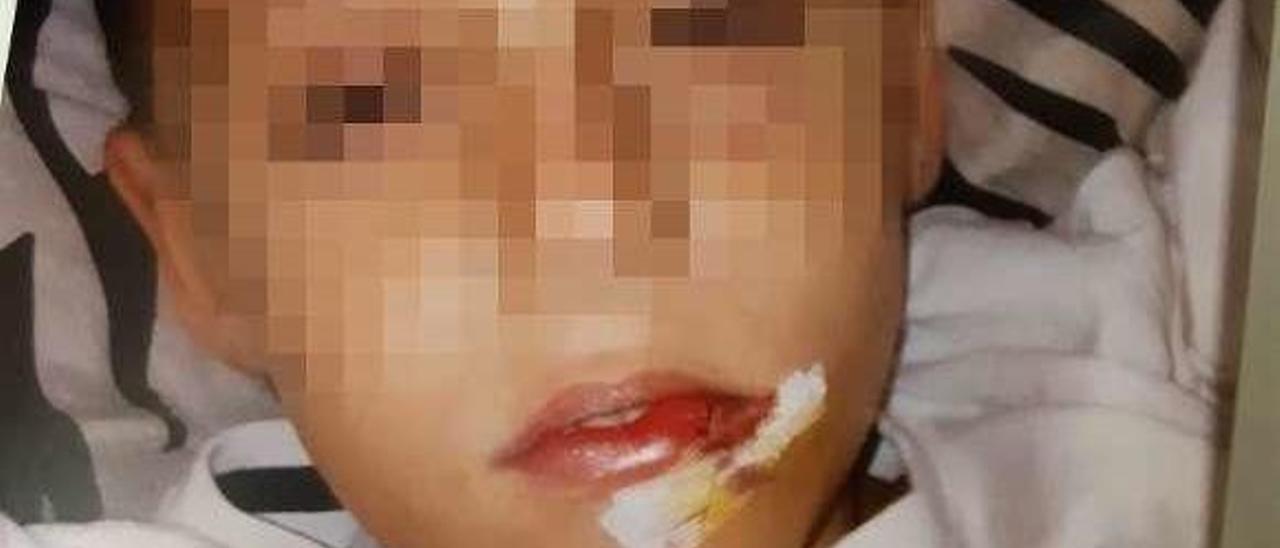 El niño de 5 años, herido en la boca tras el ataque.