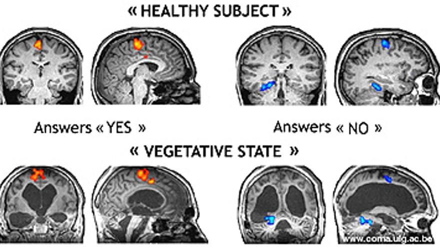 Un hombre en estado vegetativo logra comunicarse a través de un escáner