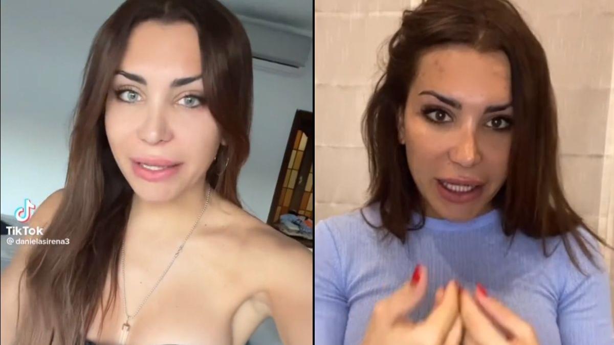 Alerta por la operación de cambio de color de ojos de una 'influencer' No compensa una ceguera por tener los ojos azules