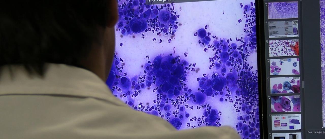Un patólogo visualiza una imagen de un carcinoma.