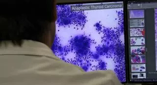 Inteligencia artificial para detectar el cáncer de mama: "Ya no miramos el microscopio, sino la pantalla"