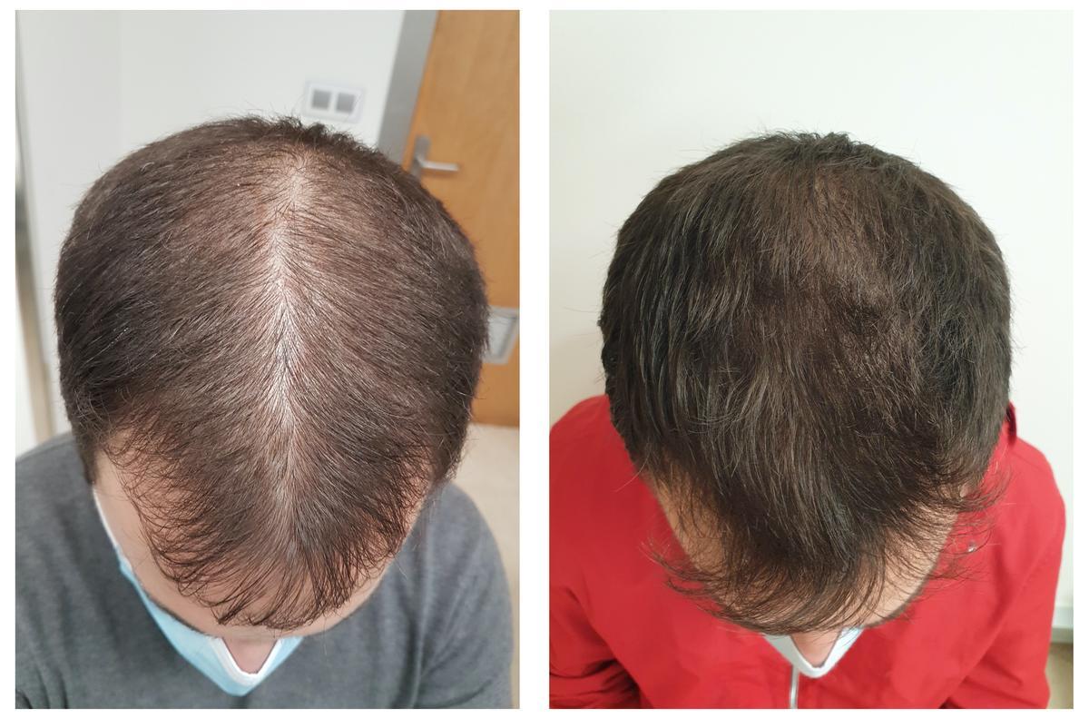 Resultados tras seis meses en un paciente varón con un tratamiento de Finasterida 1mg c/24h + Minoxidil 5% c/24h tópico