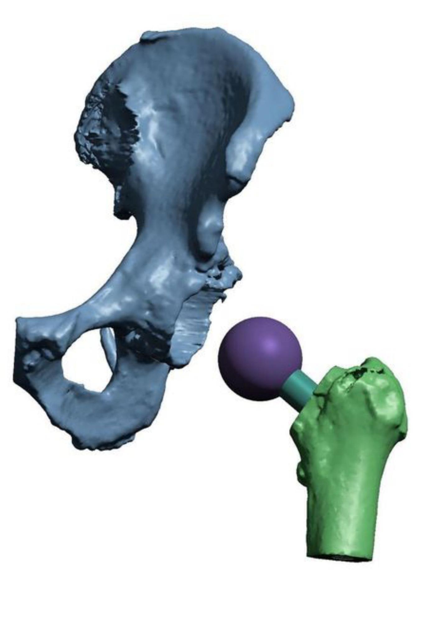 Reconstrucción digital en 3D de cadera.