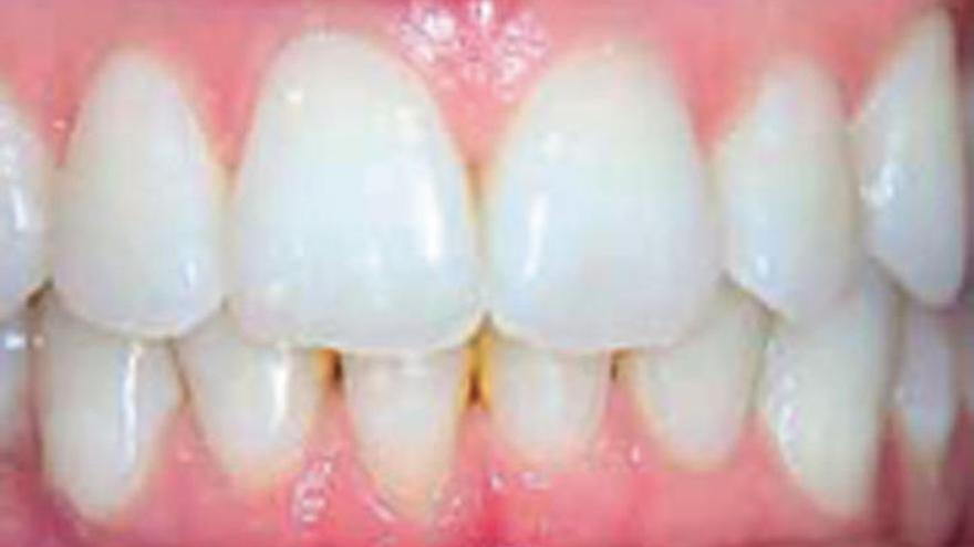 Apretar los dientes puede ser síntoma de bruxismo
