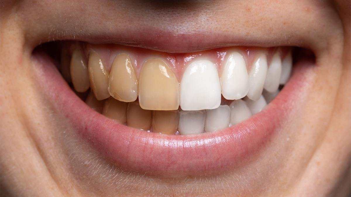 Les teves dents ha canviat de color? El senyal silenciós que pot estar avisant-te d’alguna cosa greu