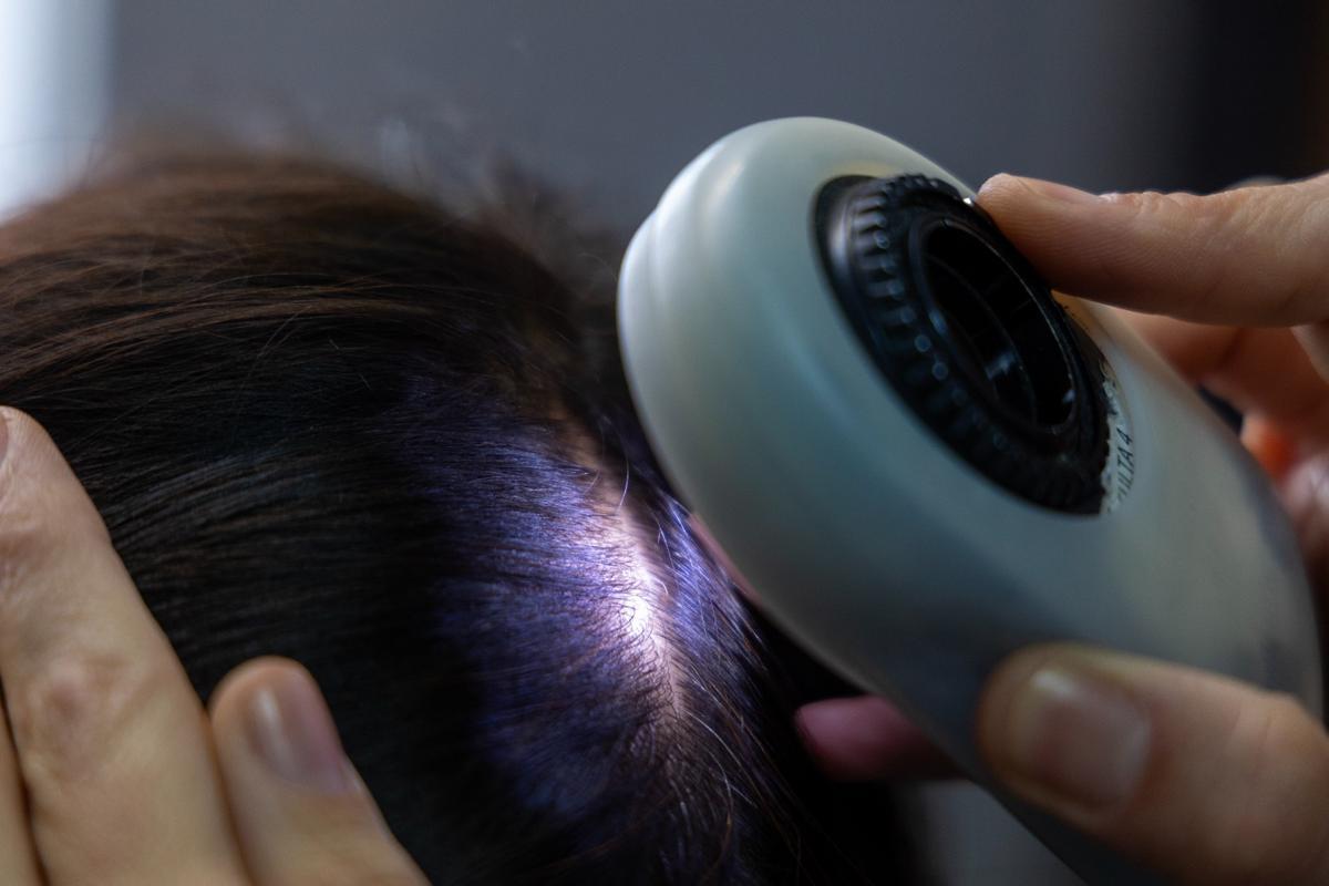 Una de cada cuatro jóvenes sufre excesiva caída del cabello y los peinados tirantes son una de las causas n Una de cada cuatro jóvenes sufre excesiva caída del cabello y los peinados tirantes son una de las causas n