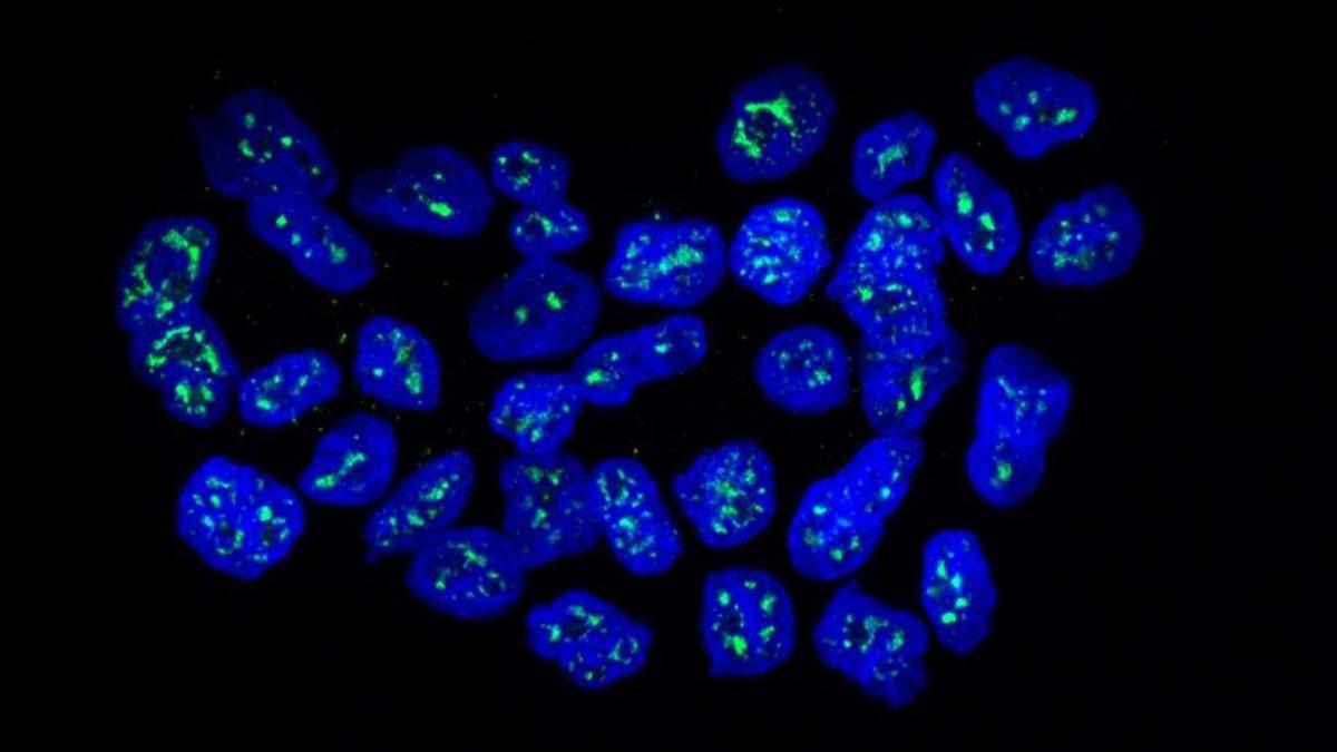 Núcleos de células metastáticas de cáncer de mama con la proteína MSK1 en verde