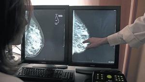 Una exploració mitjançant tomosíntesi o mamografia en 3D per detectar càncers de mama.