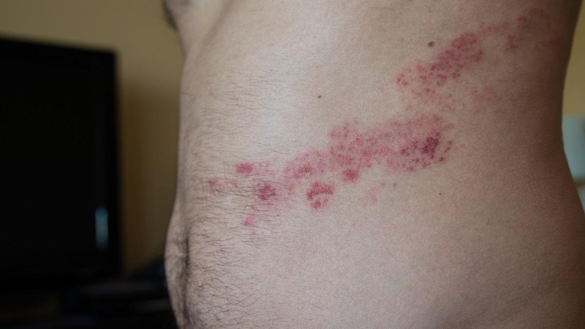 Herpes zoster: una enfermedad subestimada que puede provocar graves complicaciones.