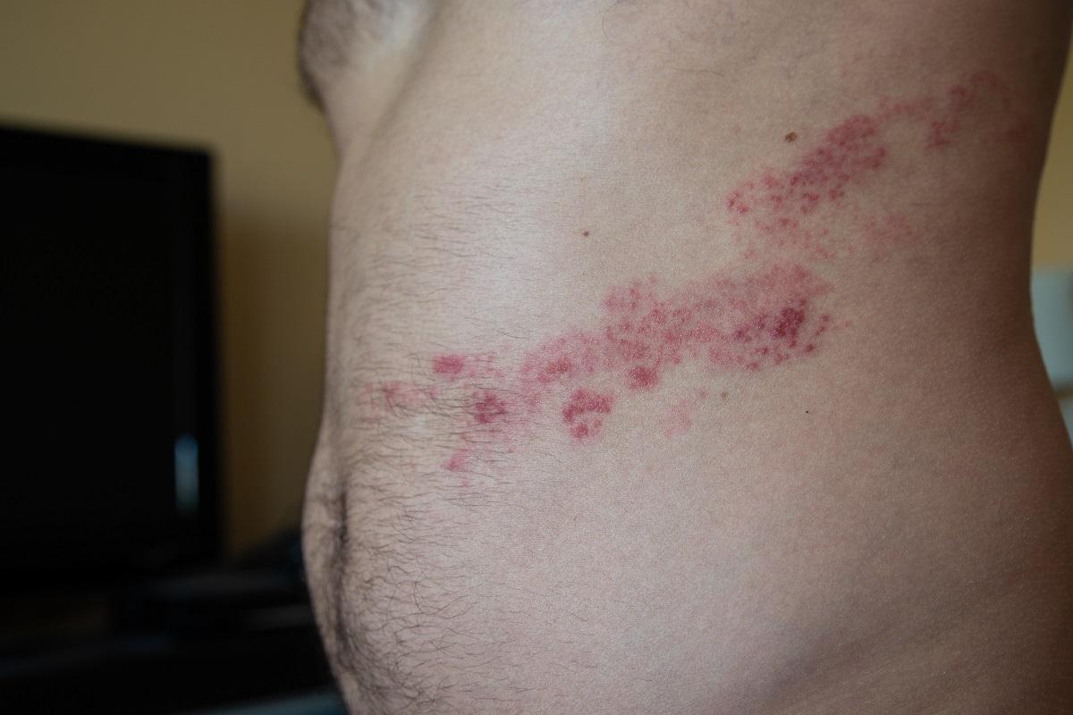 Herpes zoster: una enfermedad subestimada que puede provocar graves complicaciones.
