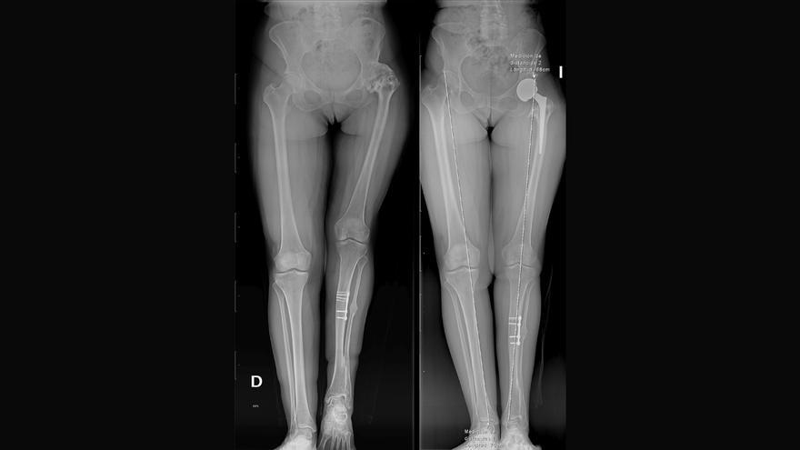 El Dr. Soler consigue un alargamiento óseo de fémur de 5 centímetros tras una sola cirugía de cadera
