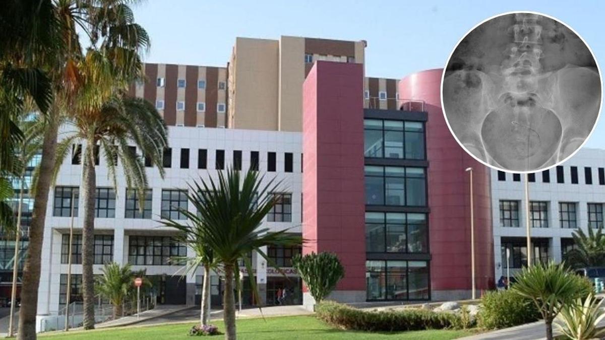Una paciente pasa 59 días con un fragmento de aguja en la pelvis tras someterse a una intervención en el Materno