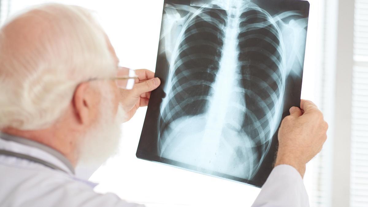 ¿Qué es un nódulo pulmonar y cómo se trata?