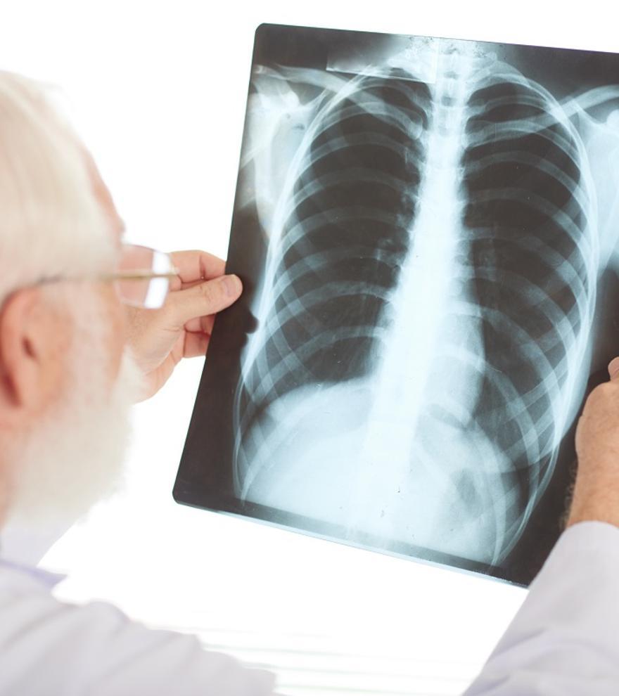 ¿Qué es un nódulo pulmonar? ¿Cómo se detecta y trata esta afección que no produce síntomas?