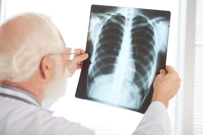 ¿Qué es un nódulo pulmonar y cómo se trata esta afección que no produce síntomas?