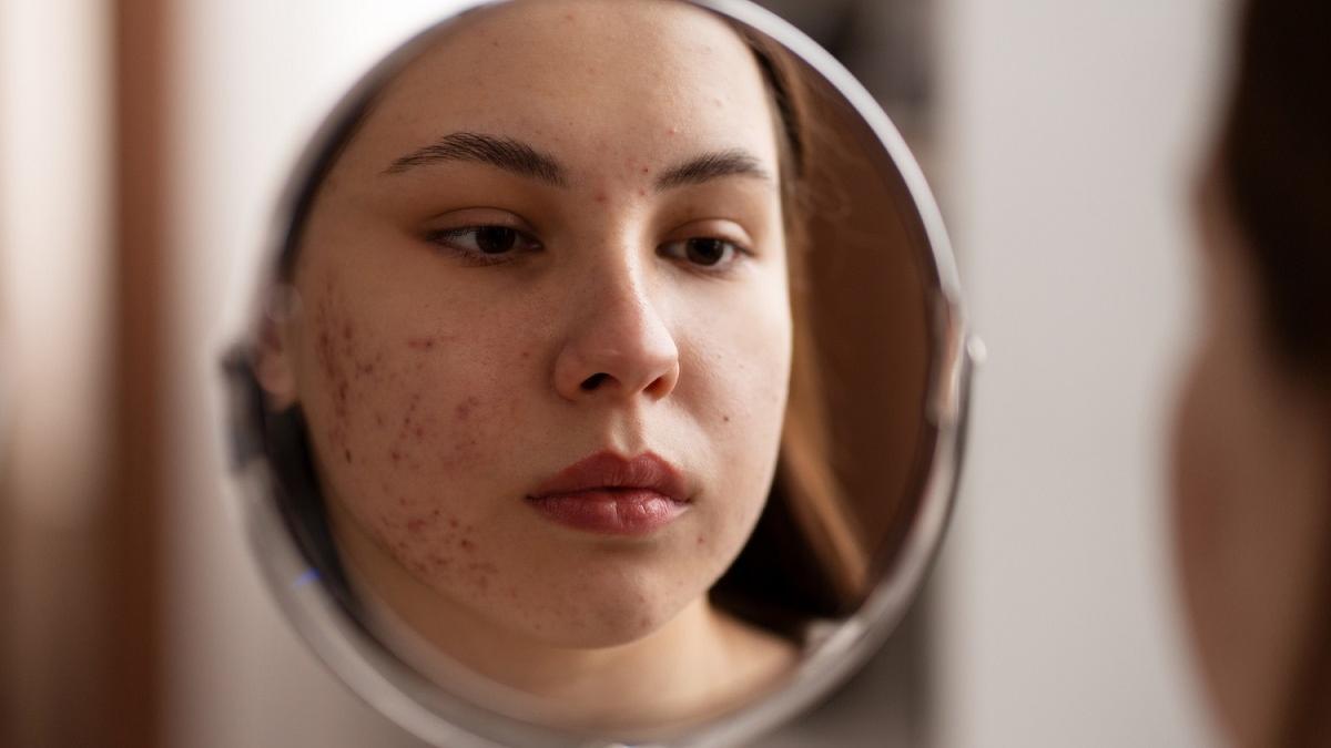 Los granos en la edad adulta puede deberse al acné persistente o al acné tardío.