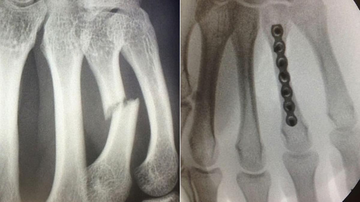 Detalle de la fractura del cuarto metacarpiano, antes y después de la operación