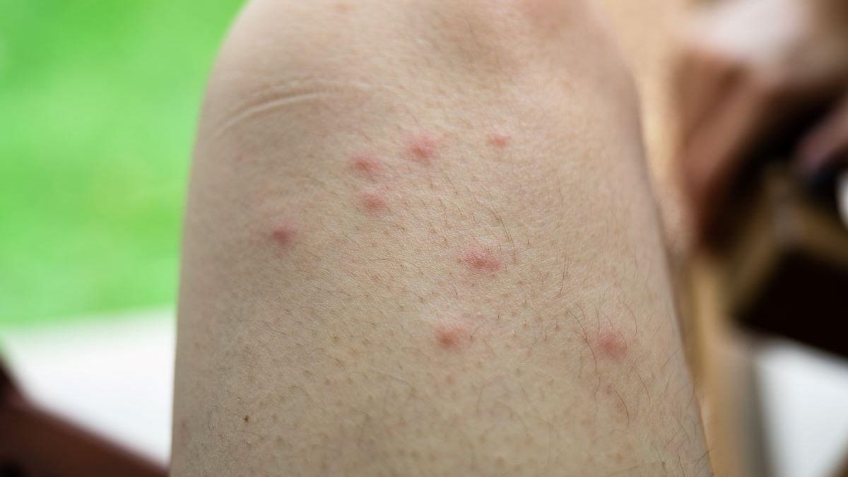 El verano es la época en la que más picaduras de insectos suelen producirse.
