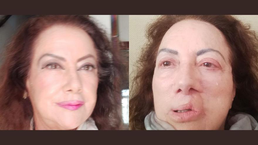 Denuncia al Servicio Andaluz de Salud por mala praxis en el tratamiento de su cáncer de piel: &quot;Me mutilaron el rostro&quot;