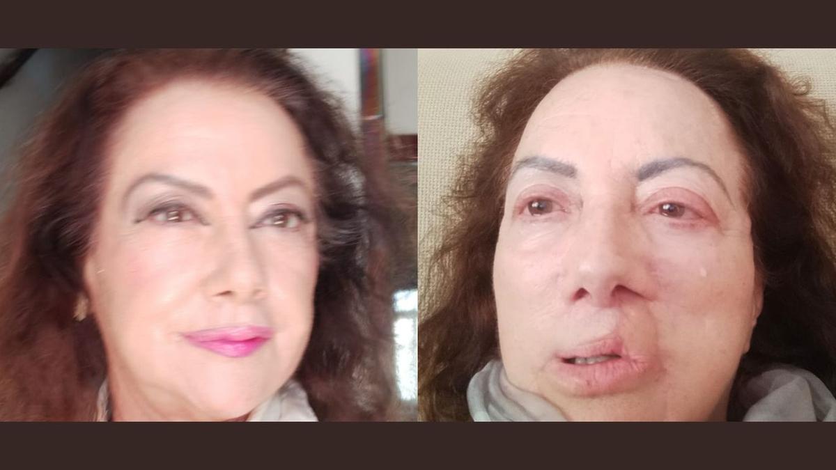 Carmen Castañeda, antes y después de someterse a la cirugía por su cáncer de piel.