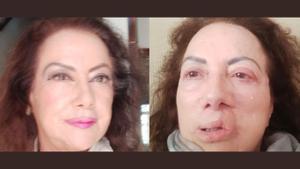 Carmen Castañeda, antes y después de someterse a la cirugía por su cáncer de piel.