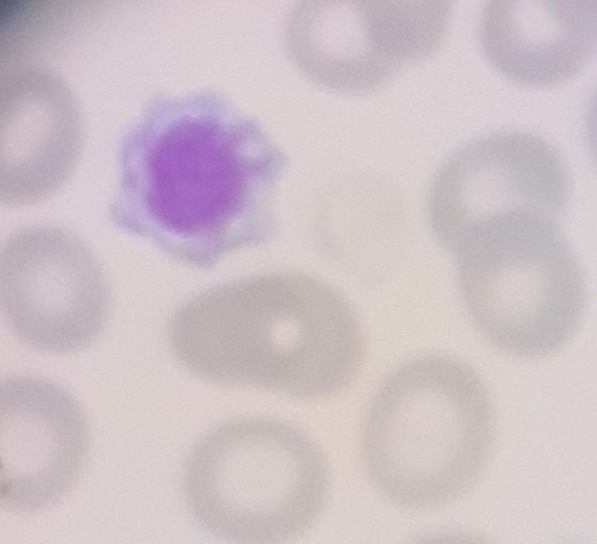 Plaqueta gigante con vacuolización en una Trombocitopenia