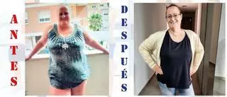 Ana, operada de obesidad mórbida: "He perdido ocho tallas. Pesaba 120 kg y usaba un andador"