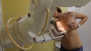 Les joves amb càncer de mama es poden sotmetre a tècniques de fertilitat