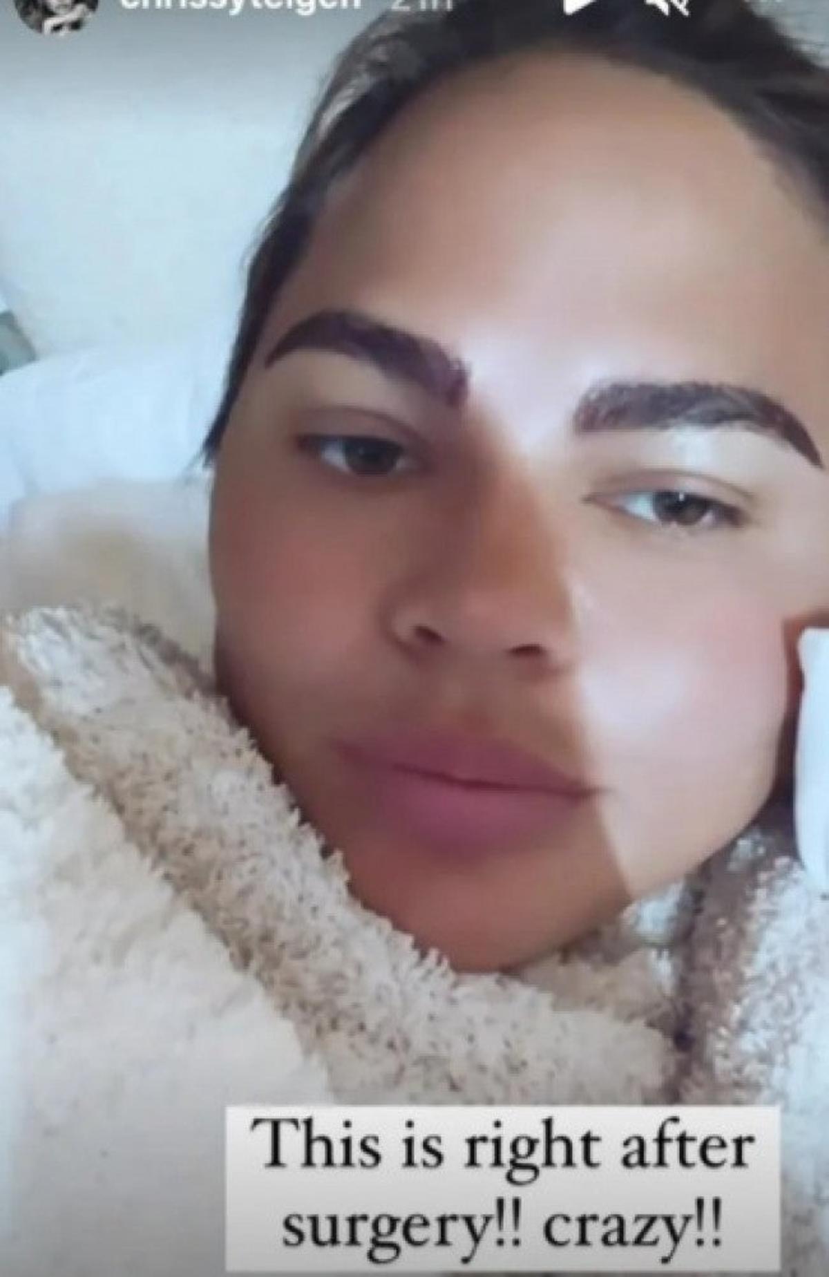 Chrissy Teigen se hace un transplante de cejas