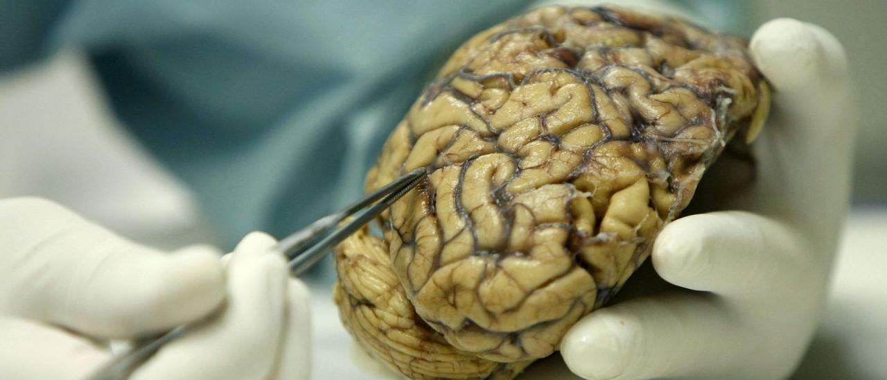 Un cerebro humano enfermo de alzhéimer. |   // FERNANDO ALVARADO