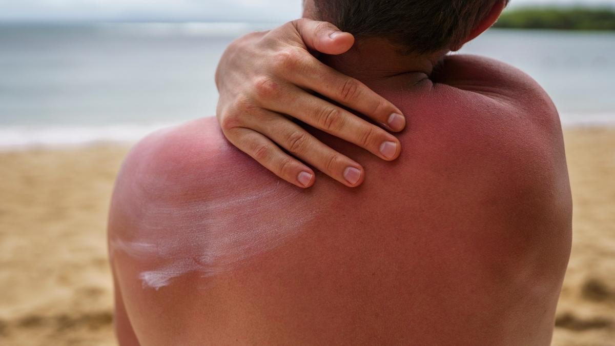 Quemaduras solares: qué hacer y qué no si te quemas en la playa