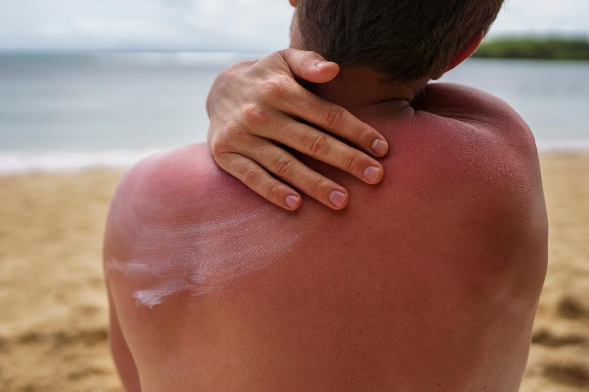 Quemaduras solares: qué hacer y qué no si te quemas en la playa