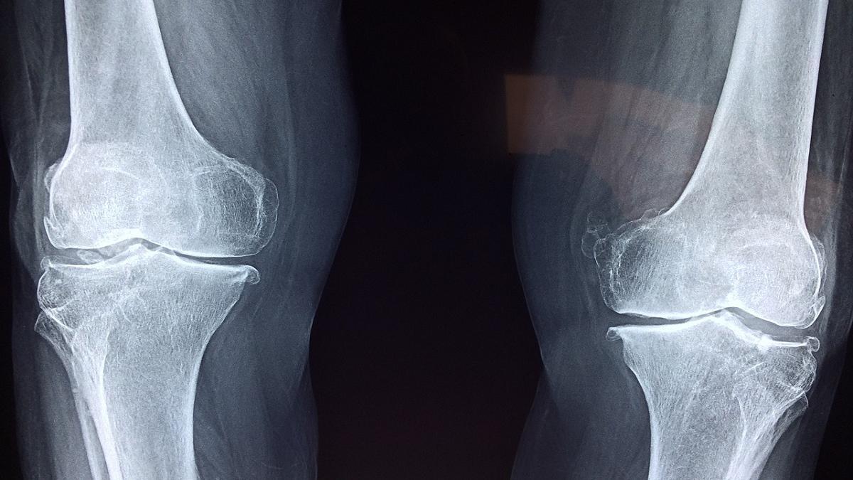 ¿Qué relación hay entre la obesidad y los problemas osteoarticulares?