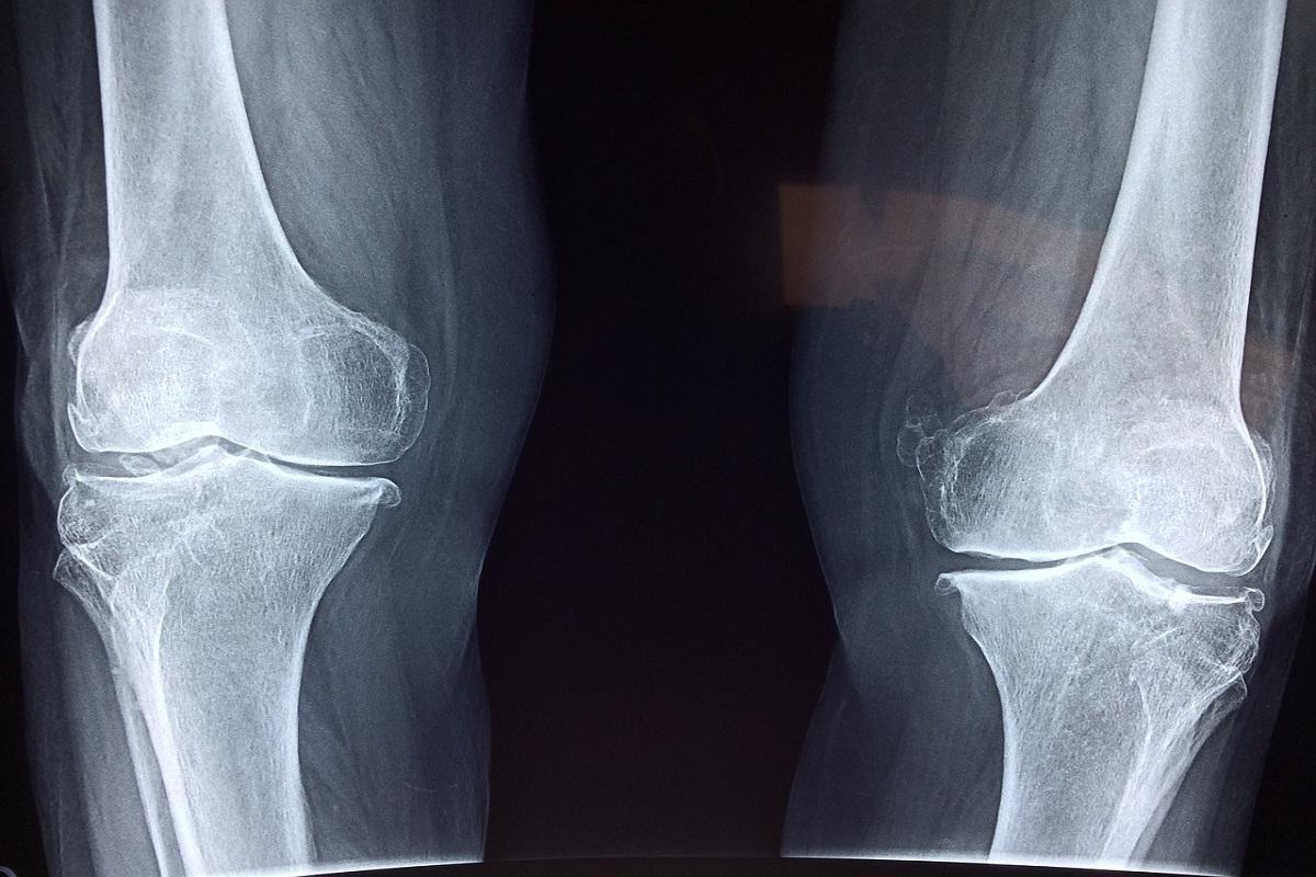 ¿Qué relación hay entre la obesidad y los problemas osteoarticulares?