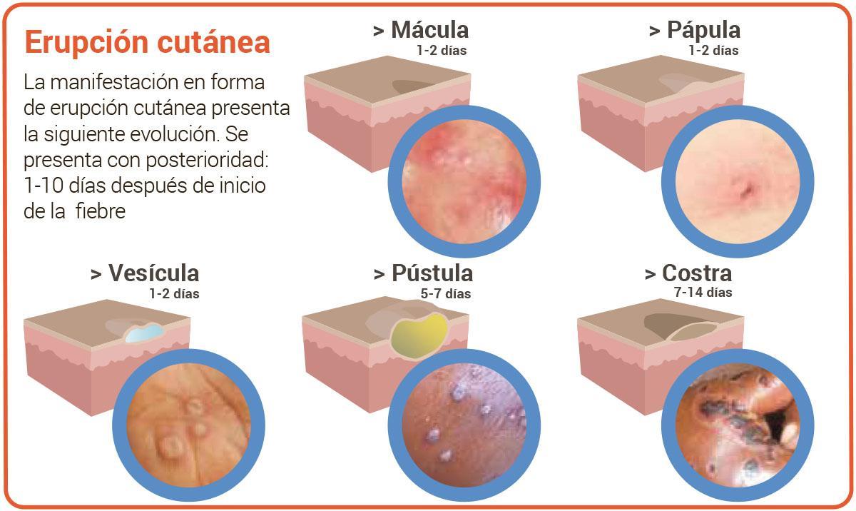 Gráfico sobre la viruela del mono.
