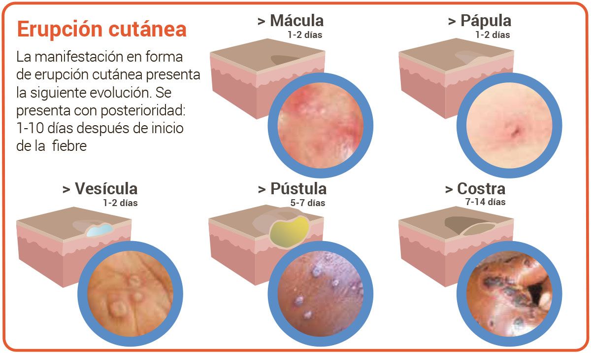 Gráfico sobre la viruela del mono.