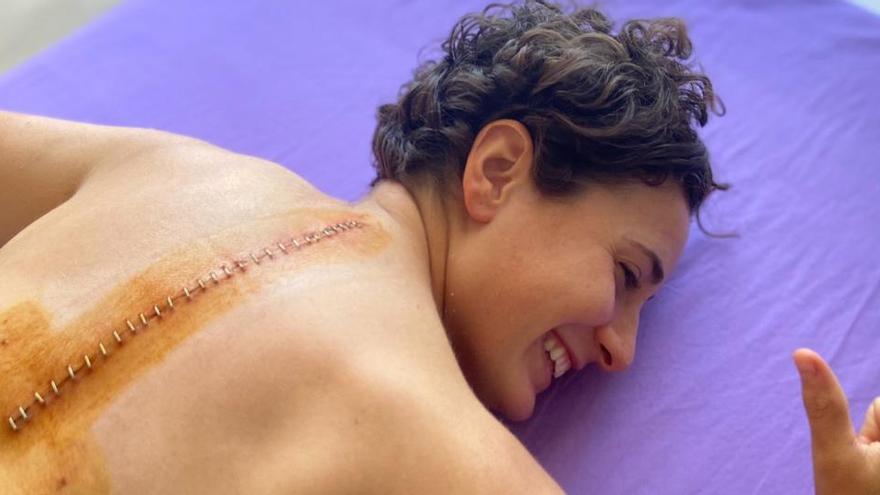 La increíble cicatriz de Ana Carrasco tras fracturarse dos vértebras
