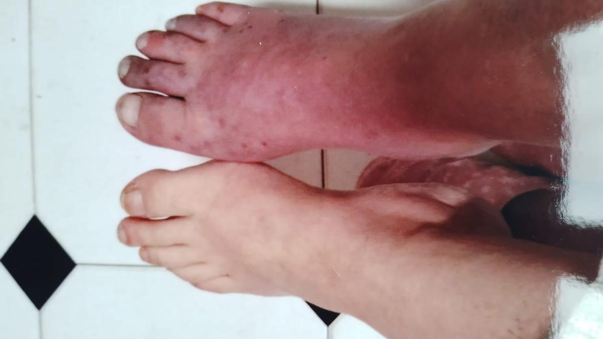 Deterioro del pie de Mónica Suárez tras la aparición de la enfermedad.