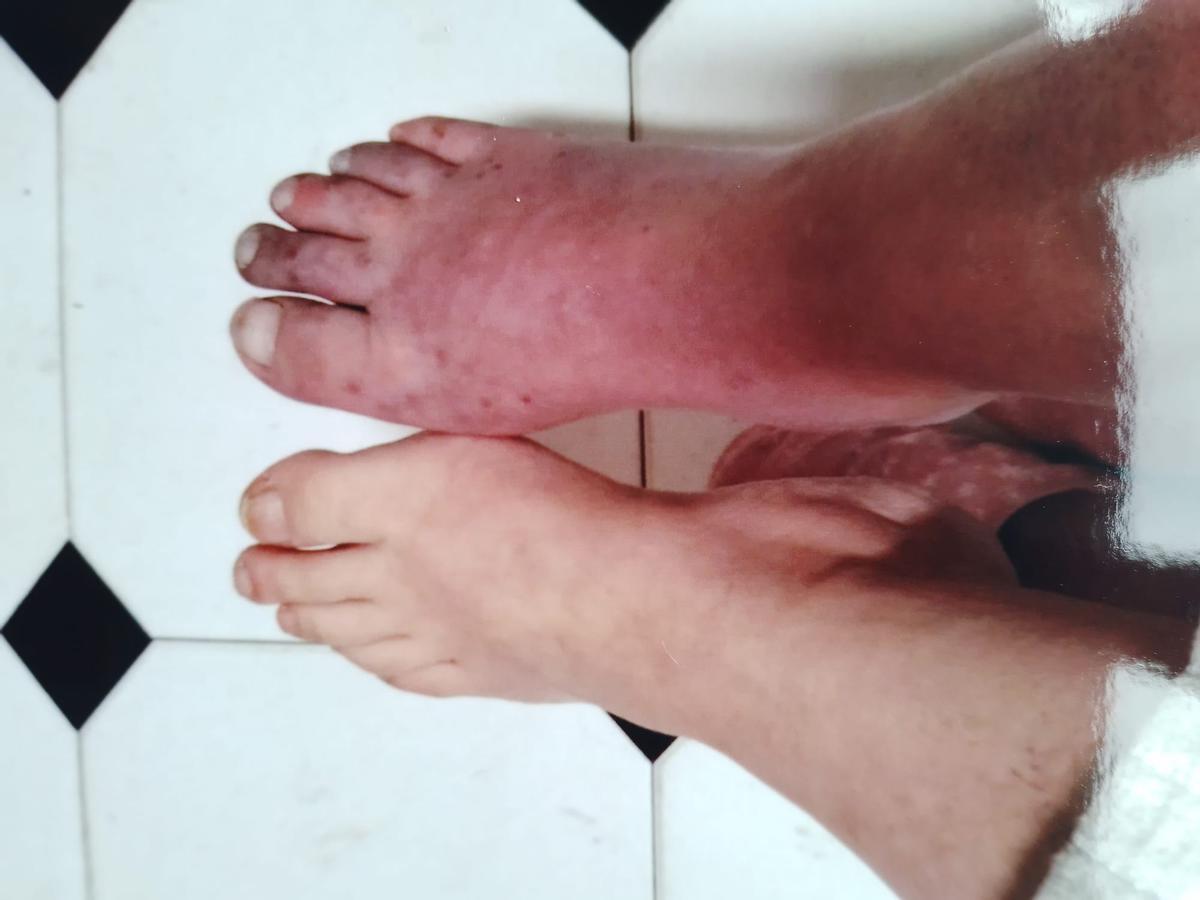 Deterioro del pie de Mónica Suárez tras la aparición de la enfermedad.
