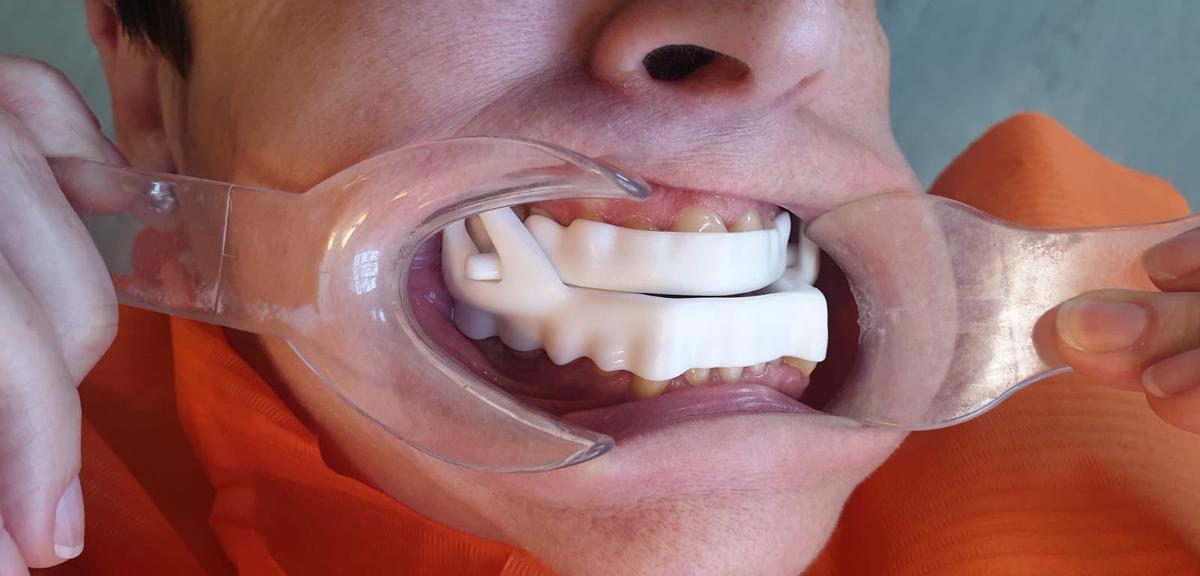 El ronquido puede ser una señal de apnea obstructiva del sueño. En Clínica Kranion, el Dr. José Manuel Torres Hortelano ofrece tratamientos personalizados con dispositivos de avance mandibular para mejorar la respiración y la calidad del descanso.