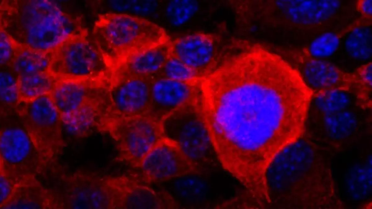 S赤ntomas para descubrir a tiempo la enfermedad m芍s mort赤fera y dif赤cil de diagnosticar