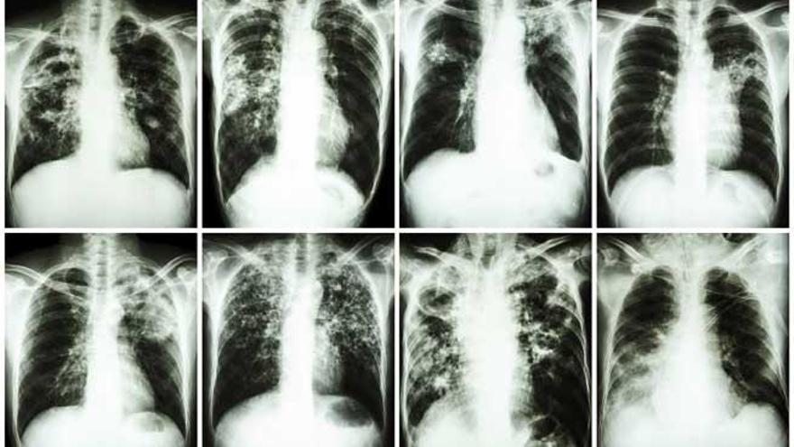 Las muertes por tuberculosis caen a la mitad en 25 años