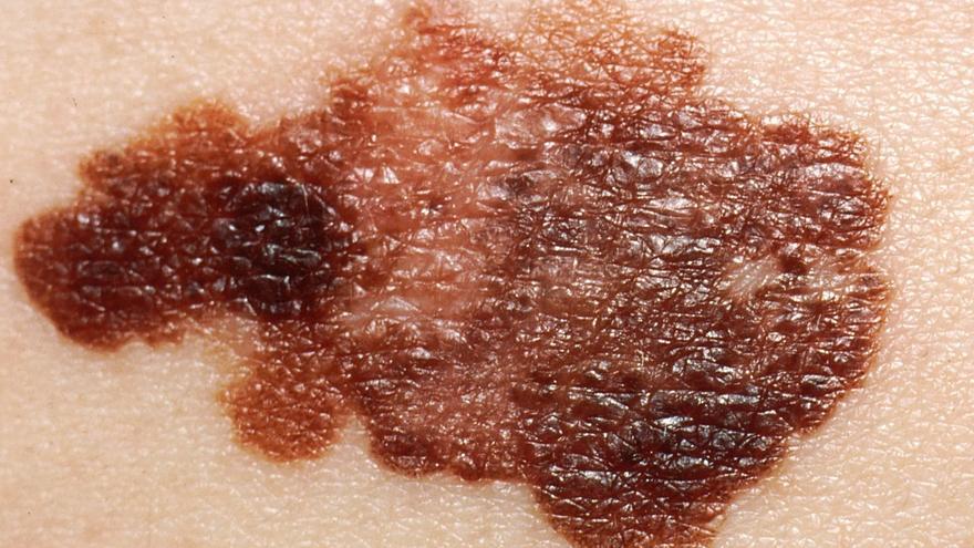 La regla ABCDE para evitar un cáncer de piel