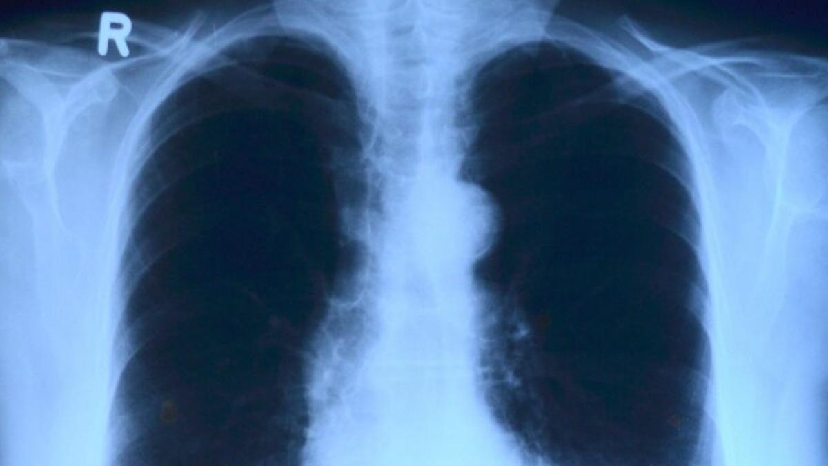 Para los que tengan enfermedades respiratorias: ¿Qué hacer con la vacuna Covid?