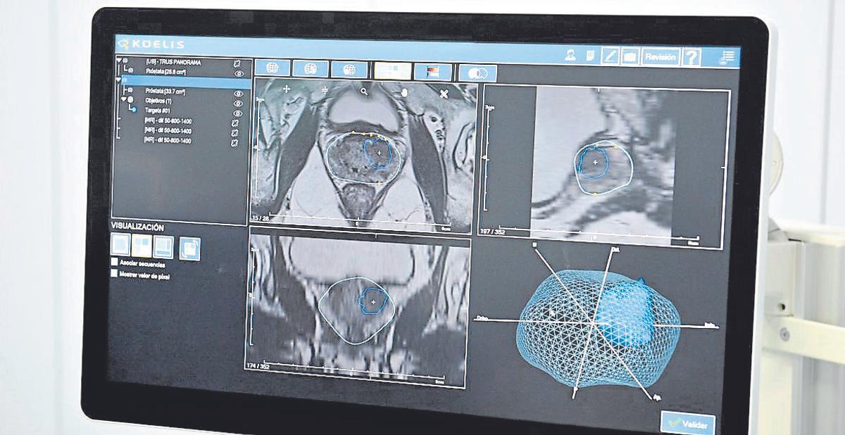 Imagen obtenida mediante la fusión de imágenes de resonancia magnética y ecografía.