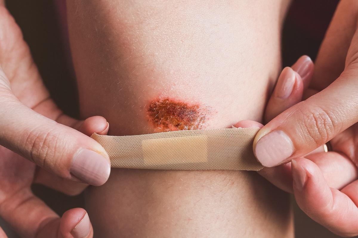 Qué hacer y qué no si te haces una herida.