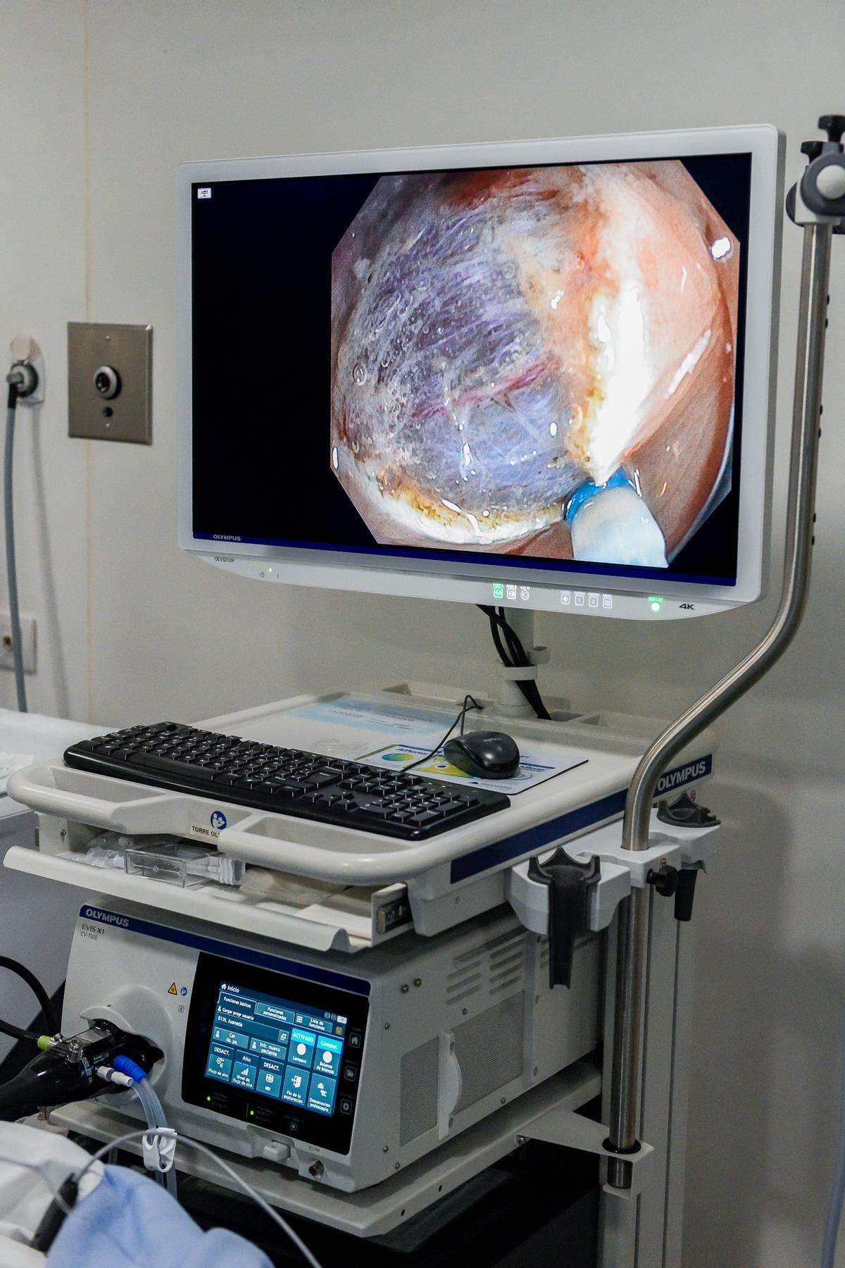 Die Endoskopieabteilung der Clínica Juaneda nutzt eine fortschrittliche endoskopische Technik zur Entfernung von Dickdarmtumoren ohne Operation.