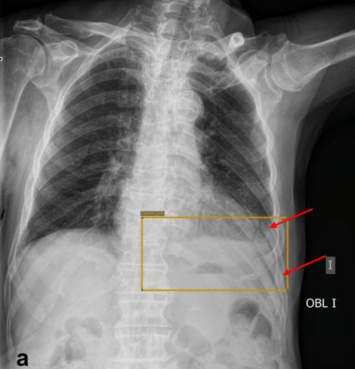 AI helps Chuvi radiologists speed up prostate cancer diagnosis