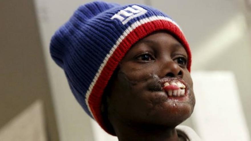 Un niño, a la espera de un trasplante de rostro